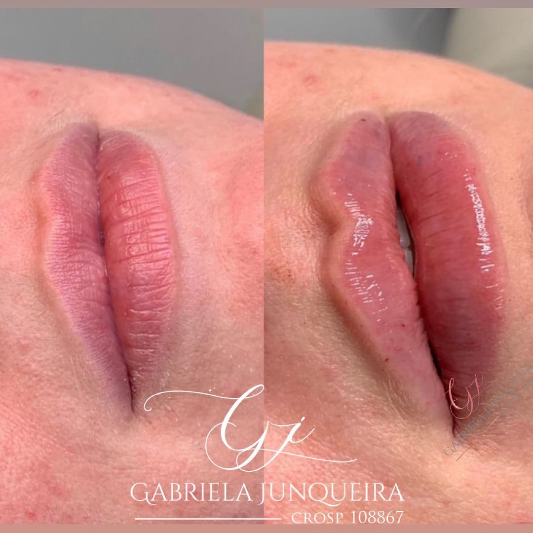 Dra. Gabriela Junqueira Preenchimento Labial #9